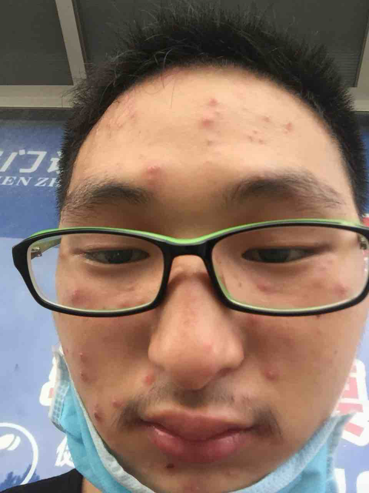 咋天长一脸水痘,去考科目三,考的成绩非常高兴