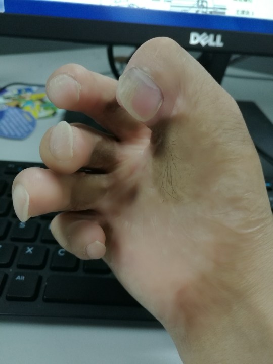 右手烧伤能报考吗